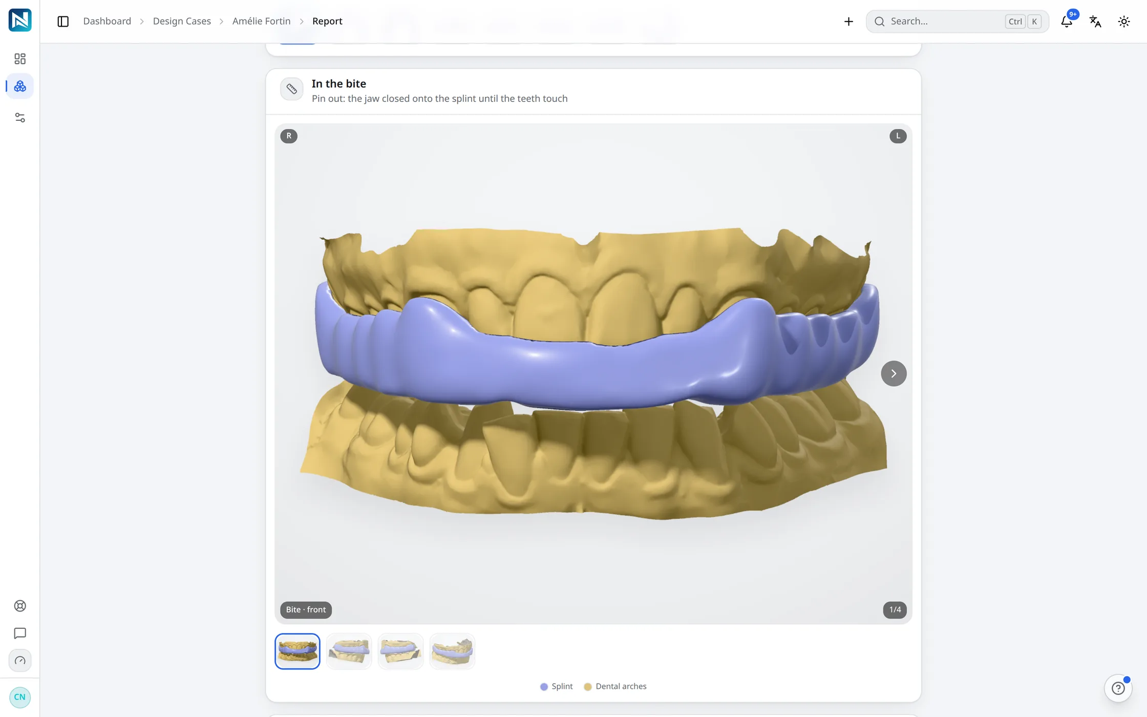 The In the bite section of the NexorCAD case report: the finished upper splint with the jaw closed onto it at its designed opening, and the other bite views below.