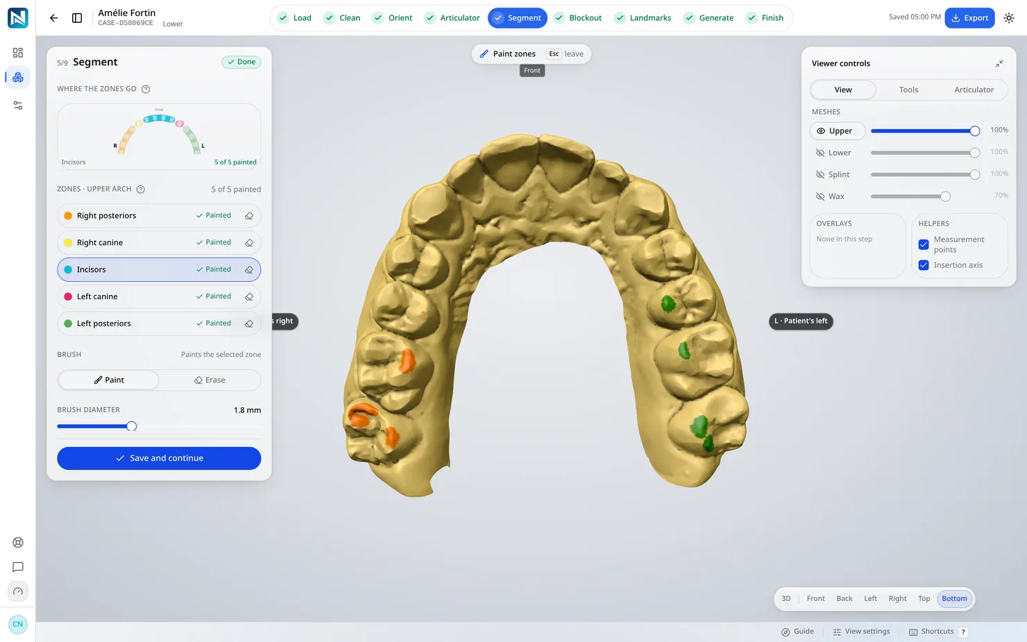 Segmentation — Les dents sont séparées de la gencive. La gouttière doit savoir sur quoi elle repose avant de décider où elle s'accroche.